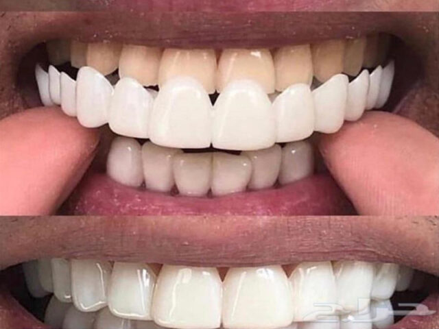 تركيب اسنان متحركة