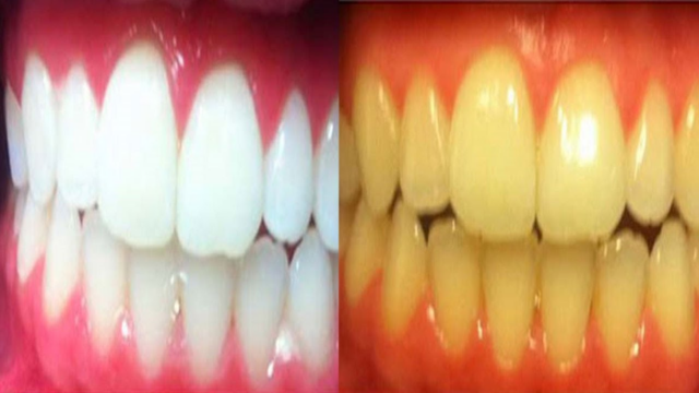 علاج اصفرار الأسنان