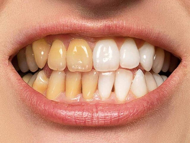 علاج اصفرار الأسنان